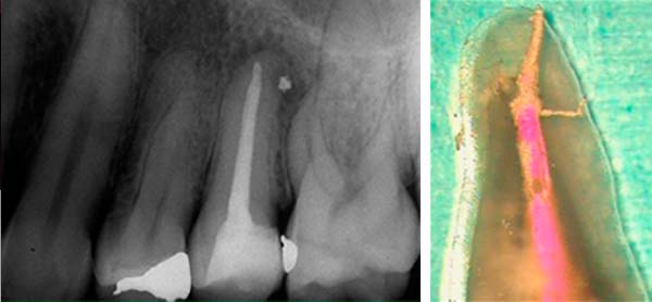 Endodoncia