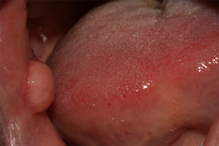 Fibroma oral