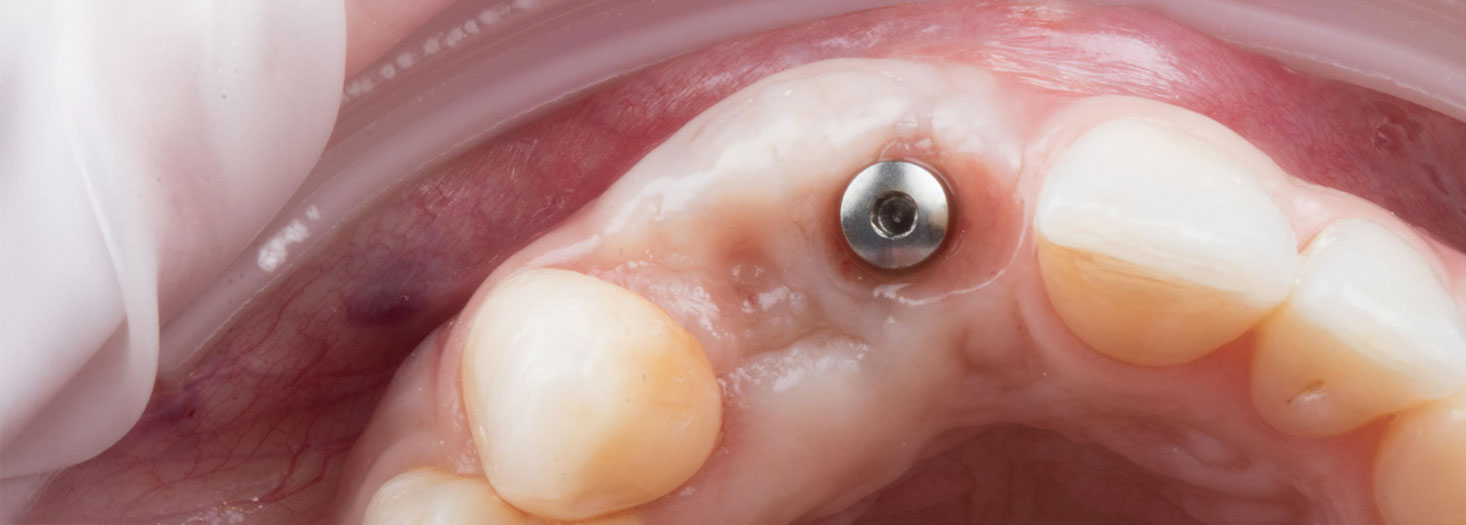 Diploma Universitario de Formación Avanzada en Periodoncia e Implantología Avanzadas